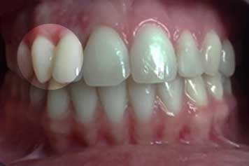 Implante por Agenesia Dentaria