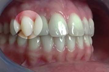 Implante por Agenesia Dentaria