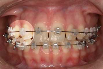 Implante por Agenesia Dentaria