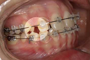 Implante por Agenesia Dentaria