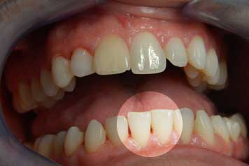 Sangrado de Encías debido al Sarro